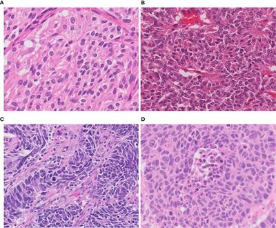 Molecular Pathology of Pulmonary Large Cell Neuroendocrine Carcinoma: Novel Concepts and Treatments